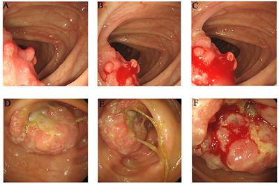 A Novel Splice-Site Mutation in MSH2 Is Associated With the Development of Lynch Syndrome